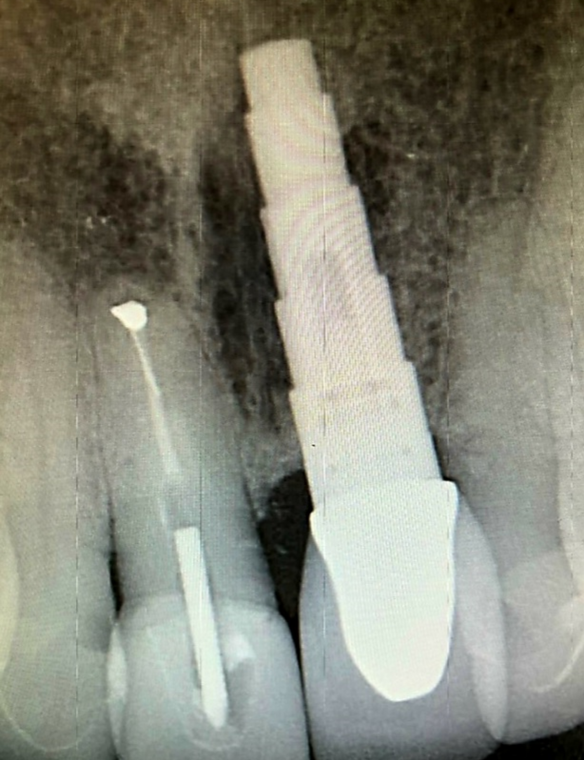Dental implant identification X-ray